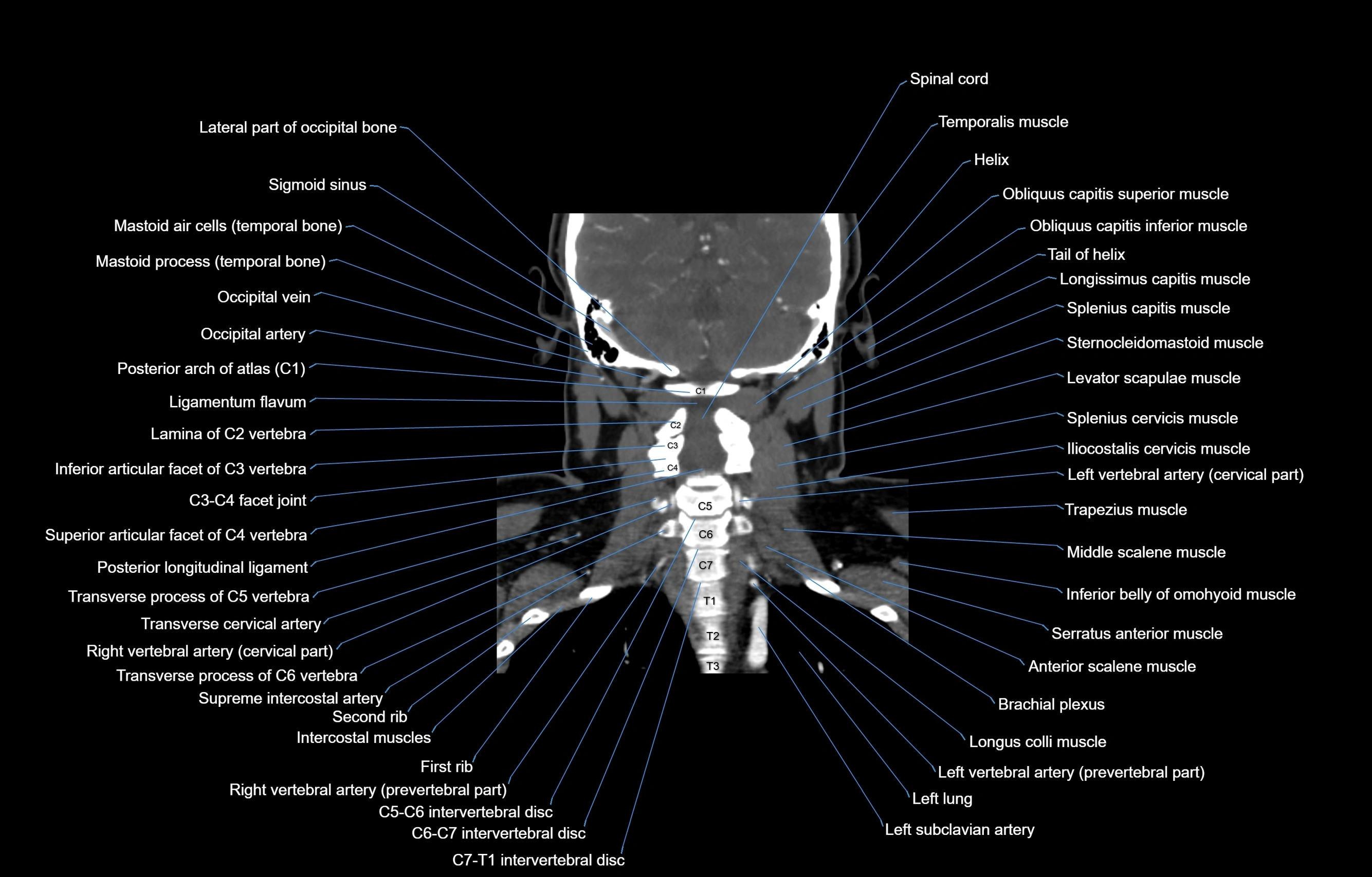 CT Neck coronal  cross sectional anatomy labelled 3D  radiology  image-00045.webp